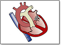 heart-valve